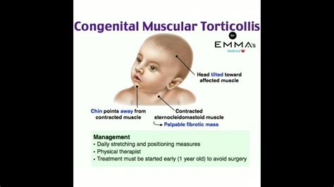 💠 congenital muscular torticollis 💠 youtube