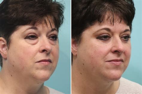 Blepharoplasty Photos Chevy Chase Md Patient 25599