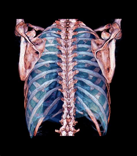 Lungs And Thorax Bones Photograph By Zephyrscience Photo Library