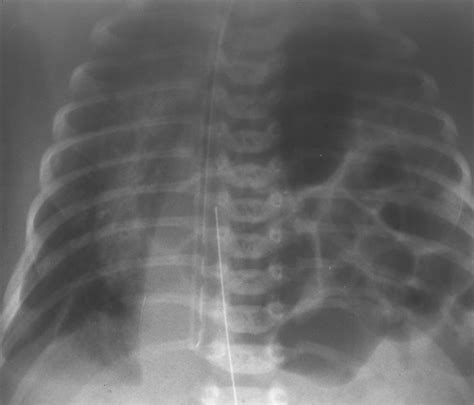 The “diaphanous” Diaphragm A Radiographic Sign Seen After Patch Repair