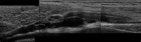 Longitudinal Composite Ultrasound Image Of Intraneural Ganglion In