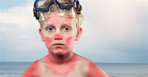 What To Do When The Child Gets Sunburned Helpful Tips My Ts List