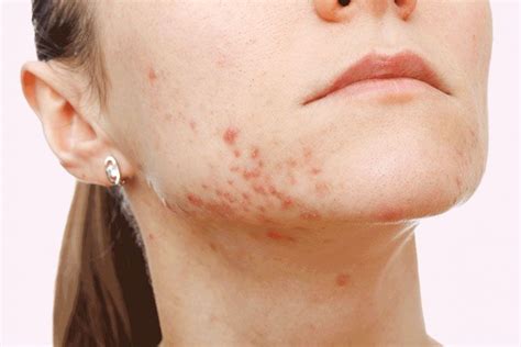 26 Natural Ways To Treat Cystic Acne