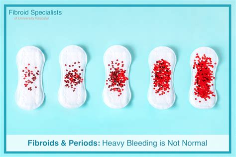 Fibroids Period Bleeding Treatment Fibroid Specialists