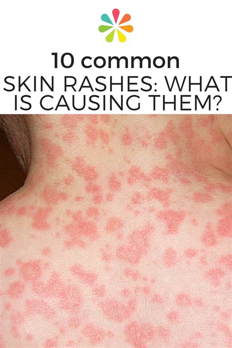 Whats Causing Your Skin Rash Skin Rash Common Skin Rashes Skin