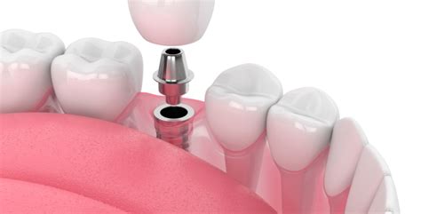 Implantes Dentales Procedimiento Tipos Y Precios Adeslas Dental 2022