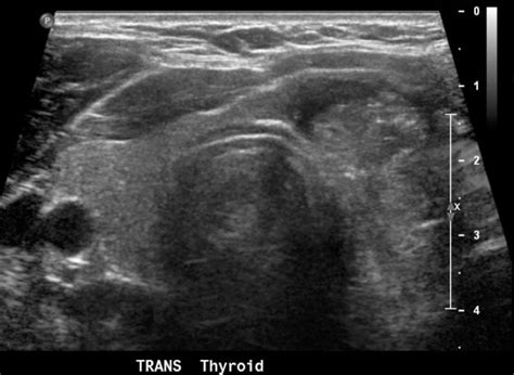 Figure Left Thyroid Nodule With Microcalcifications Contributed By