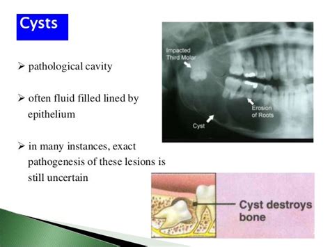 Cysts Of The Jaw Part 1