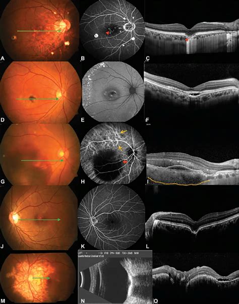 Focal Choroidal Excavation With Diverse Retinochoroidal Diseases A C
