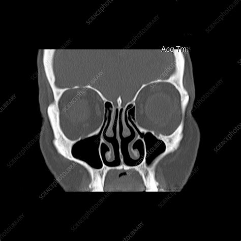 Ct Of Paranasal Sinuses Stock Image P4100085 Science Photo Library