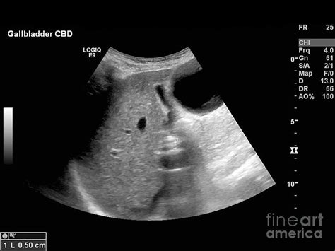 Gallbladder Disease Ultrasound Scan Photograph By Science Photo Library