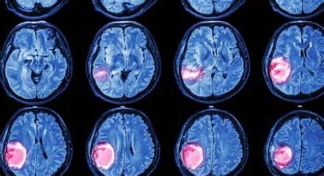Consecuencias Cognitivas De Los Tumores Cerebrales