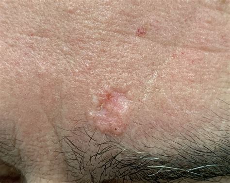 Basal Cell Carcinoma Spot Check Clinic