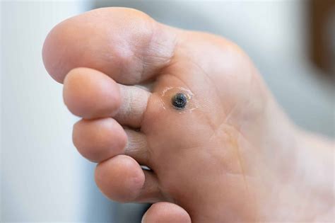 Common Warts On Feet