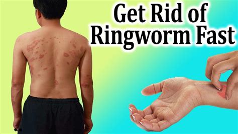 How To Get Rid Of Ringworm Naturally Here Are Top Remedies To Cure