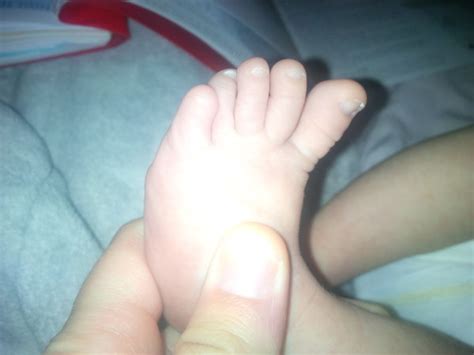 Babies With Overlapping Toes Page BabyCenter