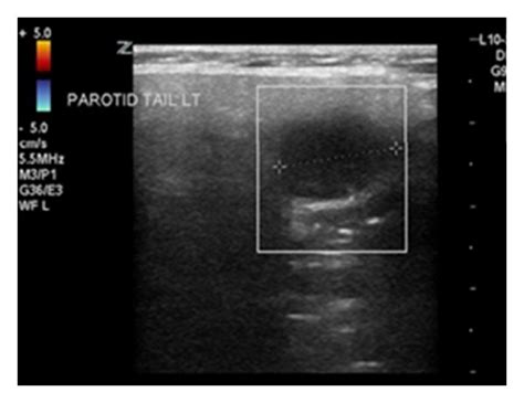 Ultrasound Of Parotid Neck Region Within The Right Parotid A Mm Download Scientific Diagram