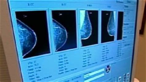 What does it mean if someone has breast dimpling vs. Dimpling skin could be a sign of breast cancer Video - ABC ...