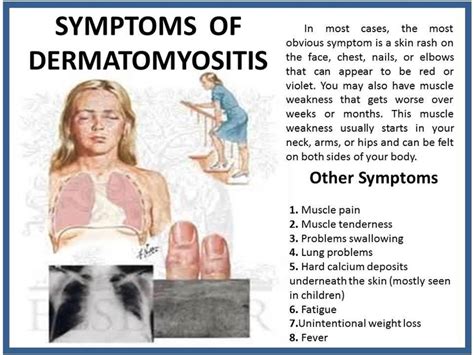 Juvenile Dermatomyositis