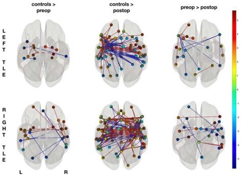 Language Network Reorganization Before And After Temporal Lobe Epilepsy