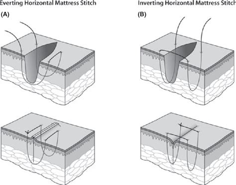 Figure 4 From The Inverting Horizontal Mattress Suture Applications In