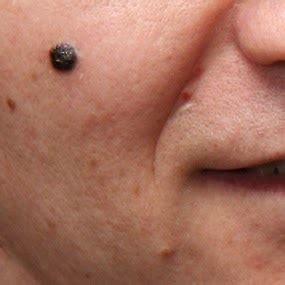 Can a Melanoma On The Face Look Like a Typical Pimple? » Scary Symptoms