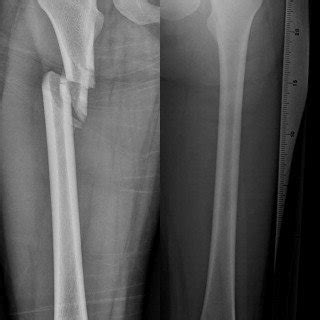 (PDF) Expert tibia nail for subtrochanteric femoral ...