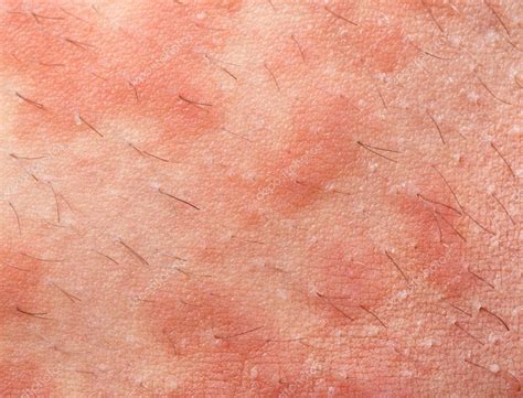 Pdf download book, let s get read or download it because available in formats pdf, kindle, epub, iphone and mobi also. Atopische dermatitis eczeem — Stockfoto © AntonioGravante ...