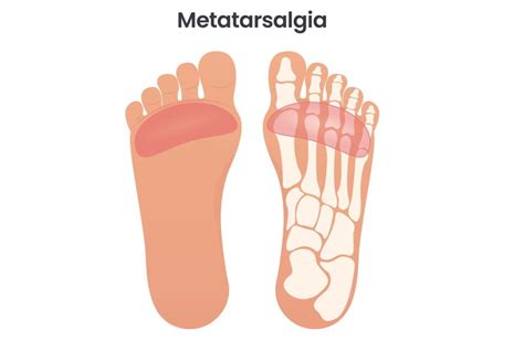 Metatarsalgia Surgery In Miami Expert Treatment For Foot Pain