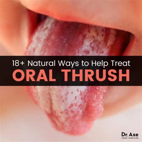 18 cách tự nhiên để chữa lành bệnh tưa miệng XUẤT XỨ ÚC