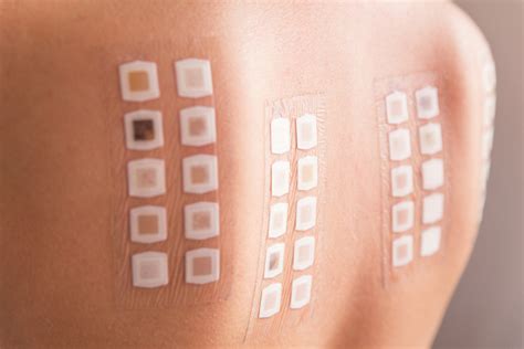 The Truth About Allergy Skin Testing Can It Help You Find Relief