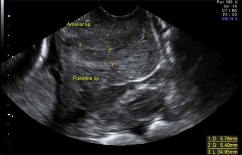 Transvaginal Image Of The Maternal Pelvis Demonstrating Cervical