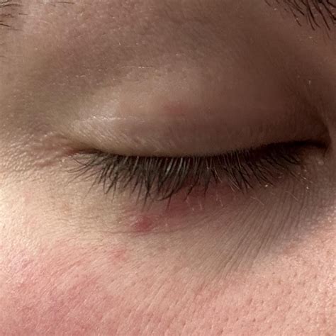 Small Red Bumpsrash Under Eye Has Been Coming And Going For A While