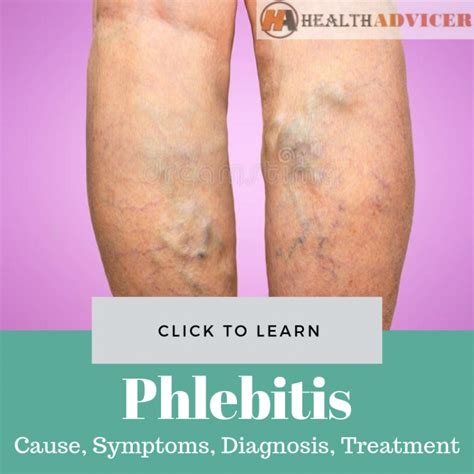 Phlebitis Causes Picture Symptoms And Treatment