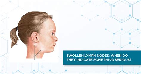 Swollen Lymph Nodes When Do They Indicate Something Serious