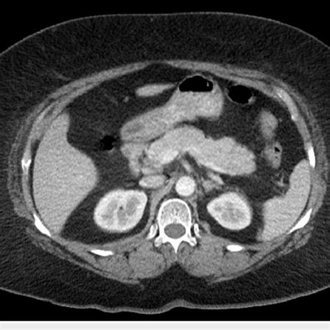 Computed Tomography Ct Scan Of The Abdomen And Pelvis With Contrast