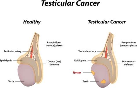 What Are The Causes Of Swollen Testicles Stdgov Blog