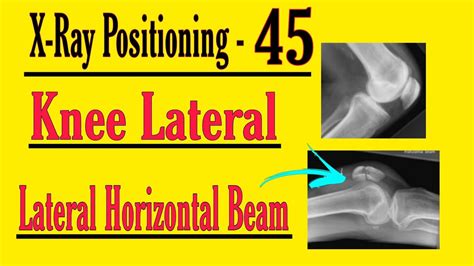 Knee Lateral And Horizontal Positioning Hindi X Ray Positioning For