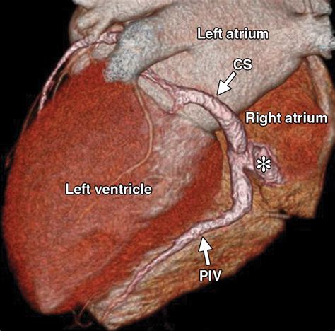 Imaging Of The Coronary Sinus Normal Anatomy And Congenital