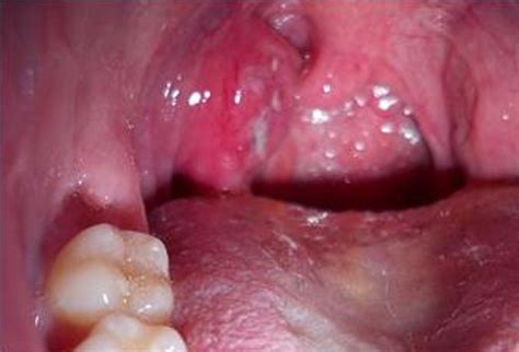 You Should Probably Know This Strep Throat Contagious Period With Antibiotics