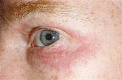 Itchy Hives Around Eyes