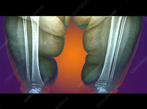 Obese Persons Leg X Ray Stock Image C0015347 Science Photo Library