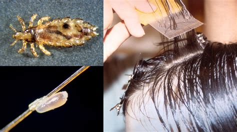 The Myths And Facts Of Head Lice Announce University Of Nebraska Lincoln