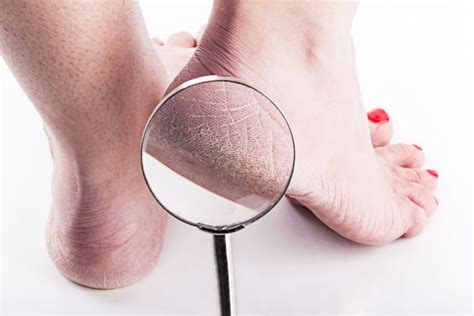 Gout Vs Cracked Heels Dermatologic Surgery Centerdermatology Surgery