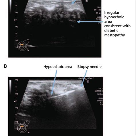 Ultrasound Scan Showing A Hypoechoic Area Of Breast Tissue Consistent