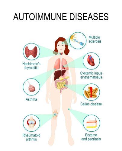 immune system diseases types symptoms prevention std gov blog