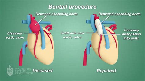 Aortic Root Replacement Bentall Procedure Rootsc