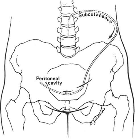 Patient Positioning For Laparoscopy Assisted Lumboperitoneal Shunt Images