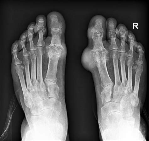Gout Symptoms Causes And Diagnosis The Foot Doc™