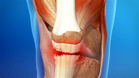 Trauma to a tendon can result in various forms of tendon injury. Ortho Blog | Patellar Tendon Tear Video